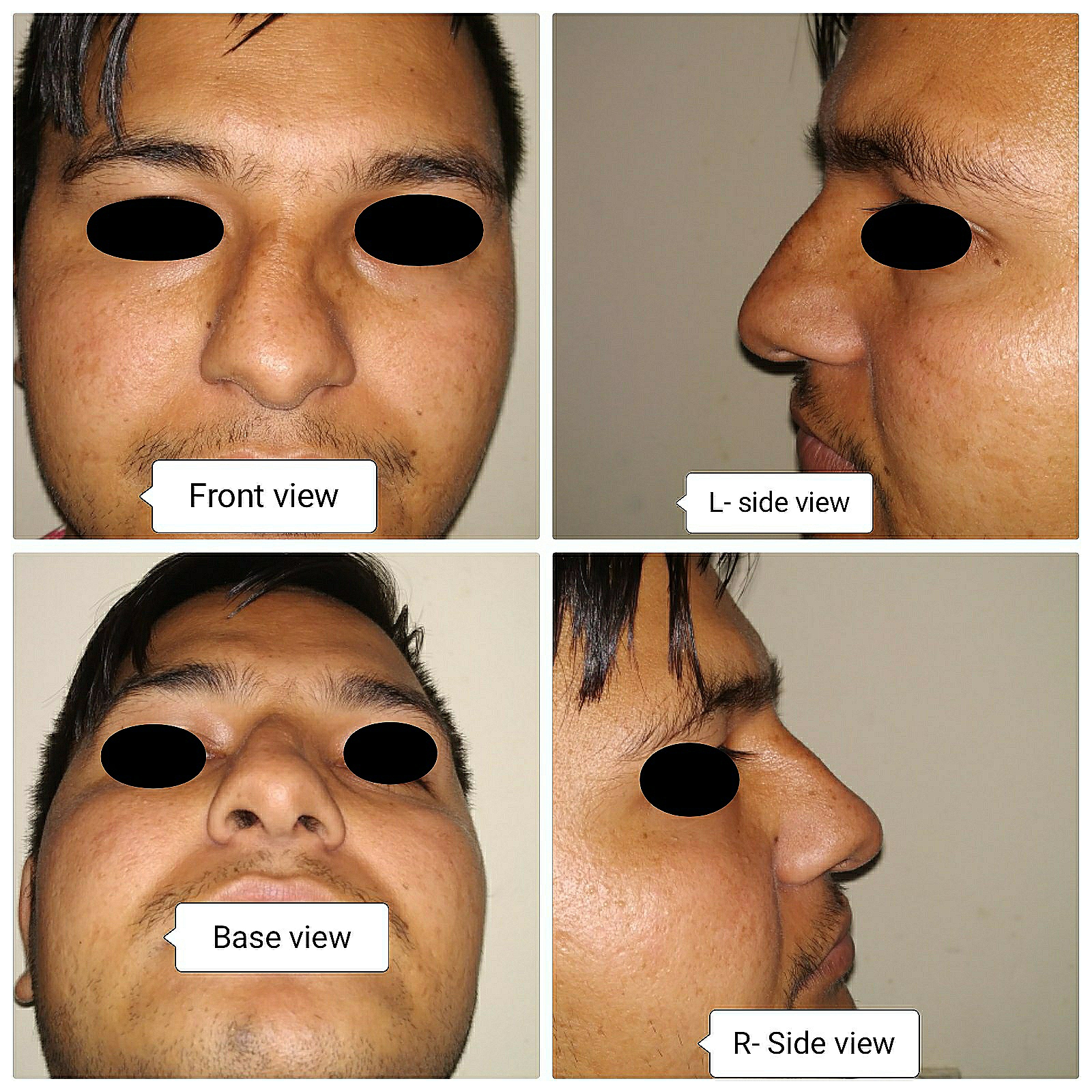 Cosmetic/Facial Plastic Surgery in Kathmandu Nepal, Dr Nayan Mahato